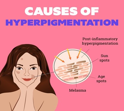 علل هایپرپیگمانتاسیون